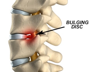 bulging disc, image