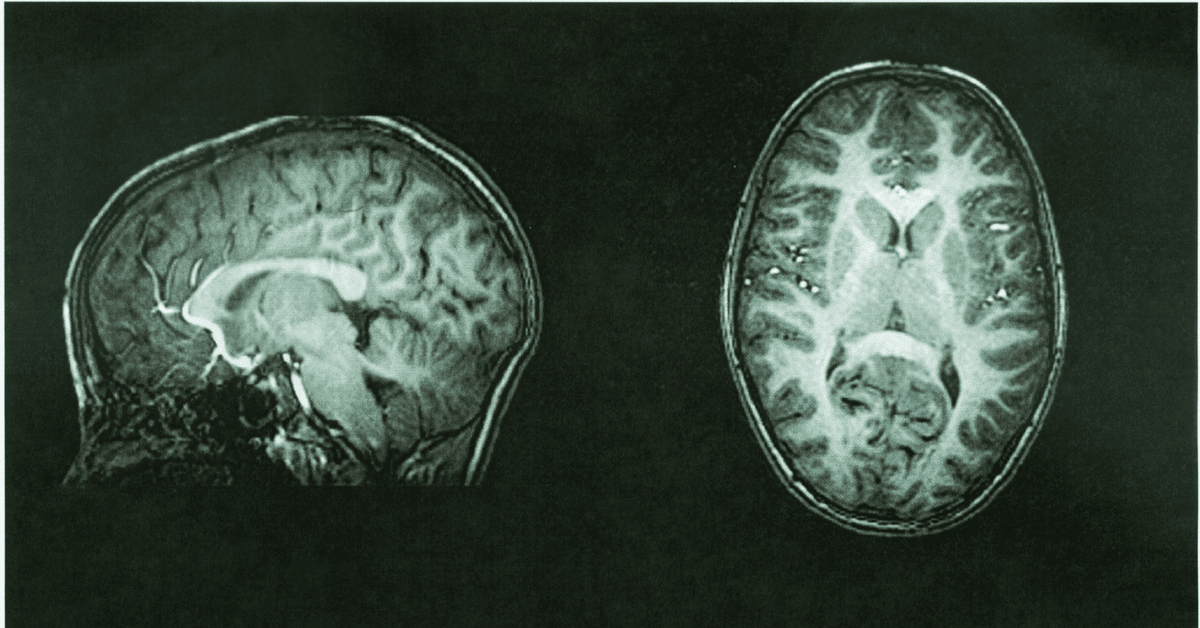 TBI Traumatic Brain Injury