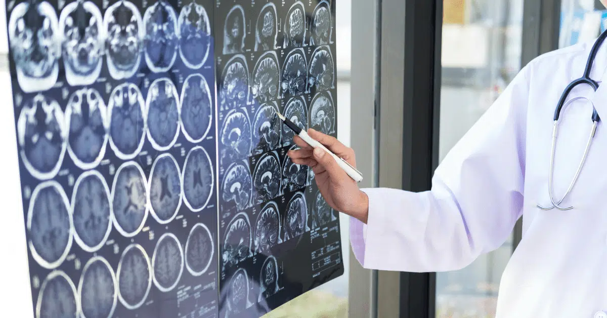 TBI law: Neurologist can't testify under closed-head injury exception because TBI patients are less than 5% of practice