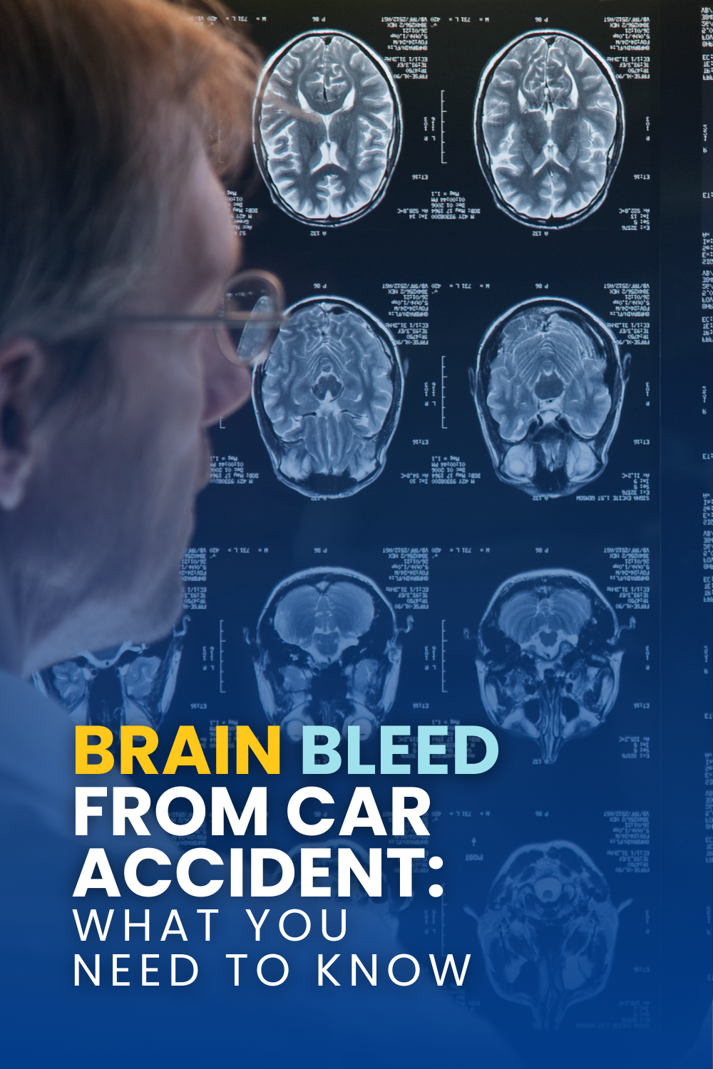 Brain Bleed From Car Accident: What You Need To Know